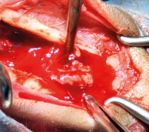 Rinotomía dorsal y “de bulking” de la cavidad nasal.