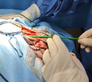 Aplicación de tratamiento de electroquimioterapia sobre el orificio de rinotomía, previo llenado de la cavidad con gel conductor.