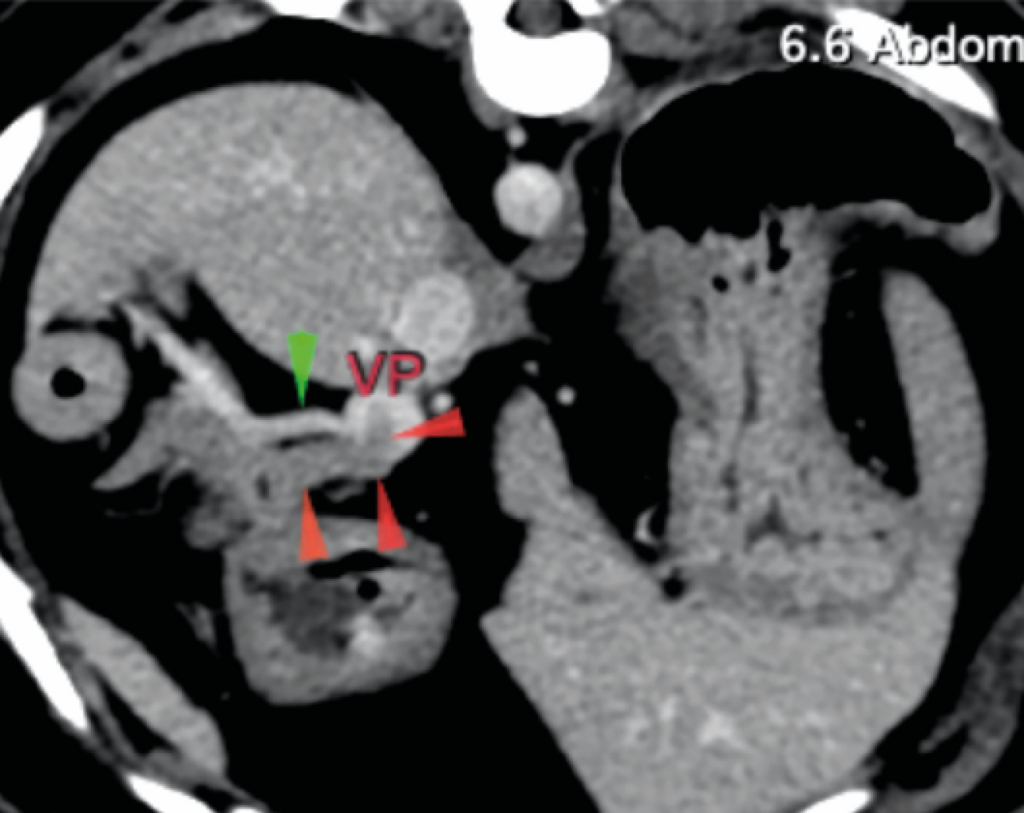 Imagen 1A. Imagen transversa de la TC poscontraste, donde se aprecia tejido blando representando el trombo tumoral (flechas rojas) que se extiende desde el páncreas e invade la vena porta (VP). La vena gastroduodenal está indiada (flecha verde)