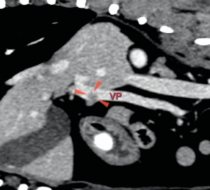 Imagen 1B. Imagen transversa de la TC poscontraste, donde se aprecia tejido blando representando el trombo tumoral (flechas rojas) que se extiende desde el páncreas e invade la vena porta (VP).