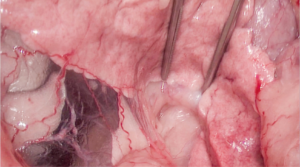 Imagen 2A. Imagen operatoria donde se aprecia, indicado por las pinzas DeBakey, un nódulo en el cuerpo del páncreas (2A)