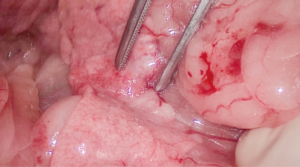 Imagen 2B. Imagen operatoria donde se aprecia, indicado por las pinzas DeBakey, un nódulo de menor tamaño en el lóbulo izquierdo (2B).