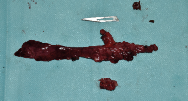 Imagen 3. Tejidos extirpados (pancreatectomía izquierda y del cuerpo con el trombo tumoral, nódulos linfáticos aumentados de tamaño y biopsias hepáticas) para ser enviados al laboratorio para su estudio histopatológico.