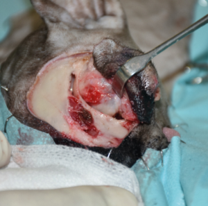 Imagen E. Secuencia quirúrgica de la resección oncológica en bloque incluyendo todo el párpado superior afectado, orbitectomía parcial dorsal y exenteración ocular, con ostectomía usando una sierra oscilante de parte del hueso nasal, y del hueso y seno frontal para garantizar márgenes amplios.