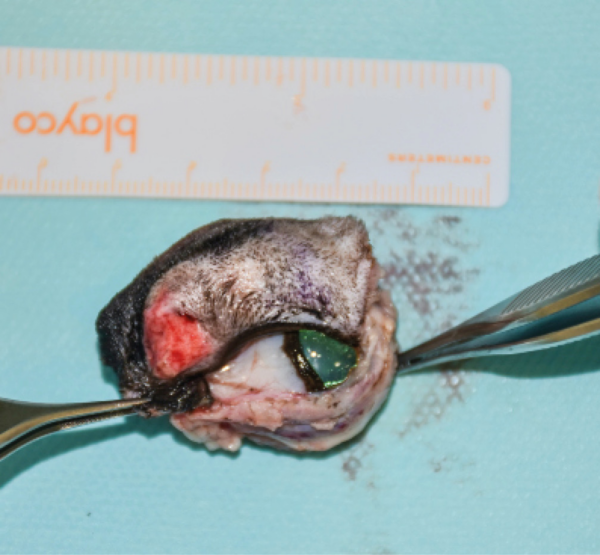 Pieza anatómica tras la resección oncológica del tumor en bloque con los márgenes amplios, antes de ser enviada para su estudio anatomopatológico.