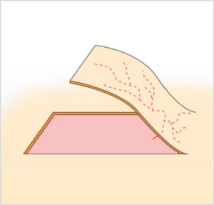 Colgajo axial insular en el que solo se preserva el pedículo vascular.