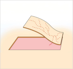 Imagen de colgajo axial peninsular manteniendo el pedículo vascular y la piel