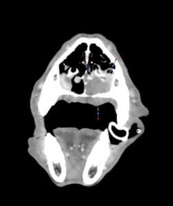 Evolución de enfermedad local en el tiempo. En el TC inicial se detectan varios nódulos pulmonares. Inicio