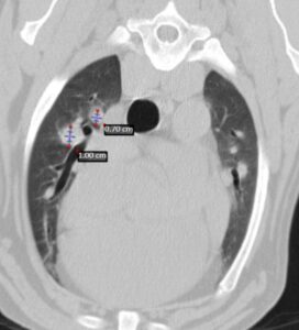 Evolución de lesiones pulmonares metastásicas en el tiempo. En el TC inicial se detectan varios nódulos pulmonares. Inicio