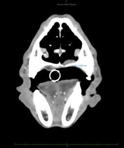 Evolución de enfermedad local en el tiempo. Tras 18 meses los nódulos pulmonares han desaparecido casi por completo tras RT.