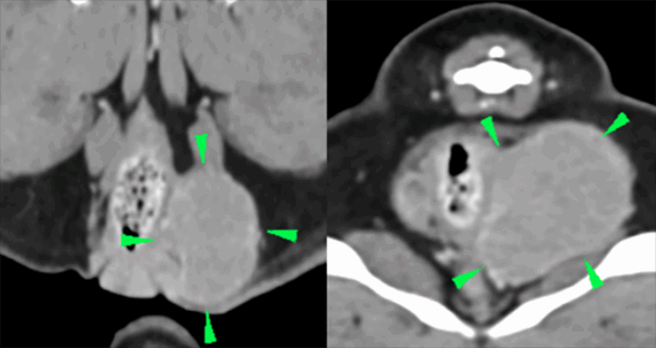 Imagen 2. Masa bien definida en el saco anal izquierdo.