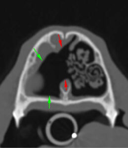 Las flechas rojas indican la lisis completa del tabique nasal en su porción media y la comunicación entre ambas cavidades nasales y las flechas verdes muestran la lisis de cornetes nasales y etmoidales.