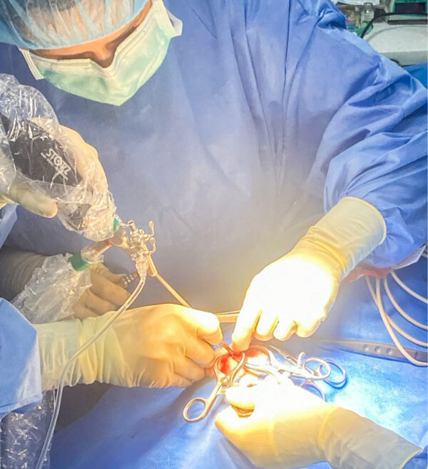 sinuscopia exploratoria del seno nasal frontal.