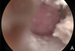 Imagen videotoscópica de un pólipo auricular felino en el oído externo.