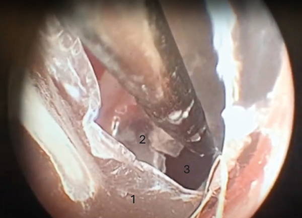 Fenestración del septo de la bulla en un paciente felino.
