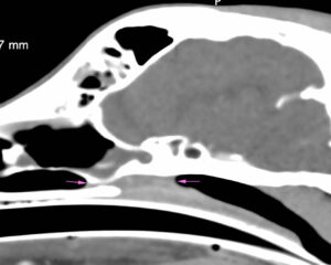 Estenosis de coanas y aspecto rostral de la nasofaringe. Las flechas rosadas indican cómo las coanas y el aspecto rostral de la nasofaringe están completamente ocupadas por material de atenuación tejido blando/líquido, con ligero realce heterogéneo tras la administración de contraste.