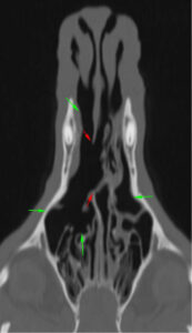 Las flechas rojas indican la lisis completa del tabique nasal en su porción media y la comunicación entre ambas cavidades nasales y las flechas verdes muestran la lisis de cornetes nasales y etmoidales.