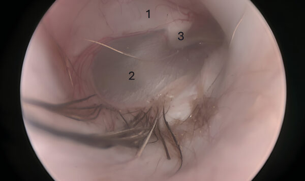 Imagen videotoscópica de un tímpano sano