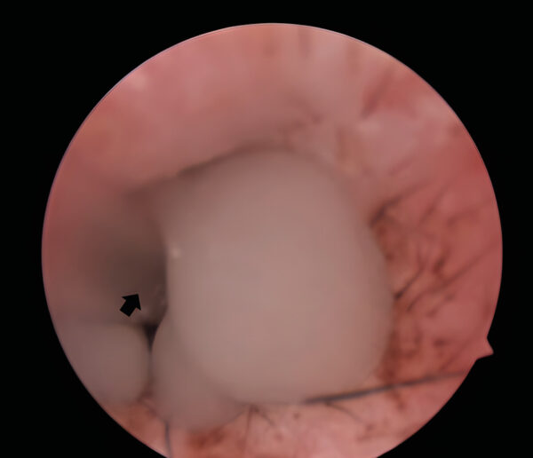 Presencia de material mucoide en el conducto auditivo externo, proveniente del oído medio tras una miringotomía.