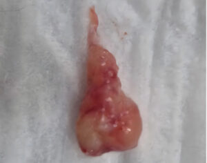 Imagen videotoscópica de un pólipo auricular una vez extraído