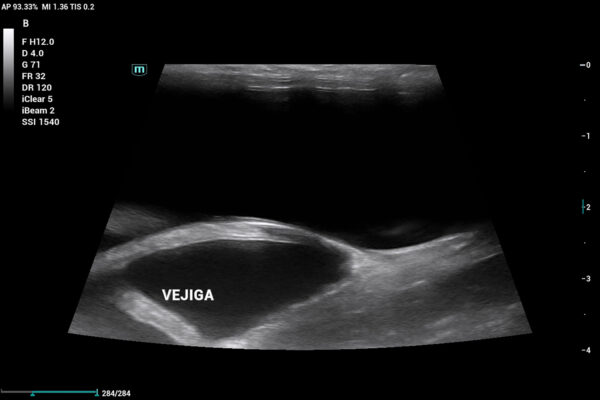 Imagen ecográfica que evidencia la dilatación aguda de los cuernos y el cuello uterino en toda su extensión con contenido anecoico en su interior.