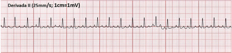 Electrocardiograma de perra chihuahua con soplo sistólico apical izquierdo grado II/VI.