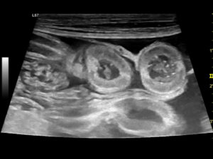 Imagen A - Ecografías de un bulldog francés de 8 años con signos clínicos compatibles con EPP