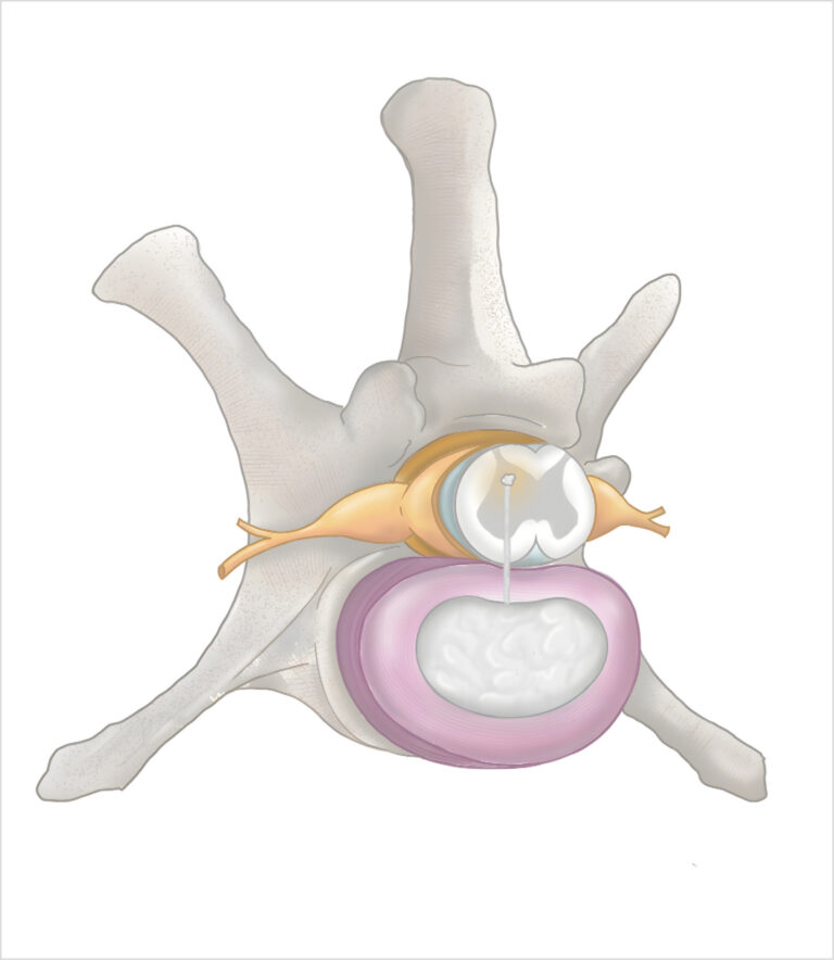 Ilustración de la estructura de una vértebra con disco intervertebral