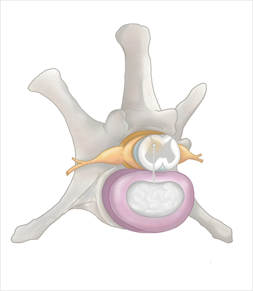 Ilustración de la estructura de una vértebra con disco intervertebral