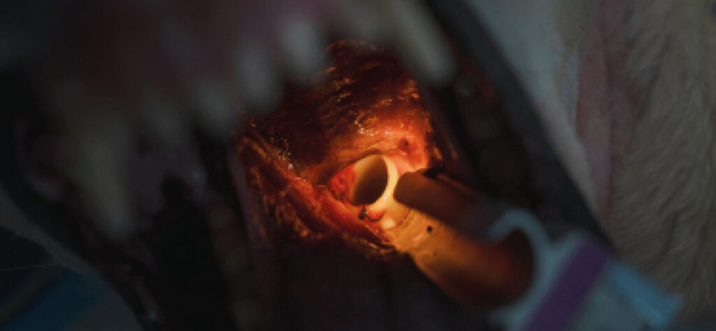 Colocación del stent﻿ laríngeo mediante abordaje oral.