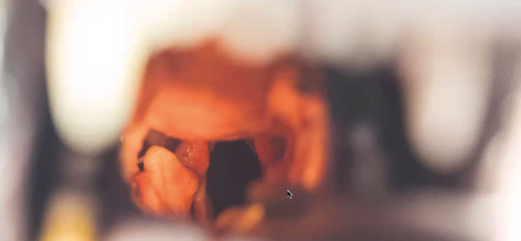 Vista intraoral caudal durante la intervención quirúrgica. Se aprecia la apertura glótica tras la lateralización del aritenoides izquierdo.﻿