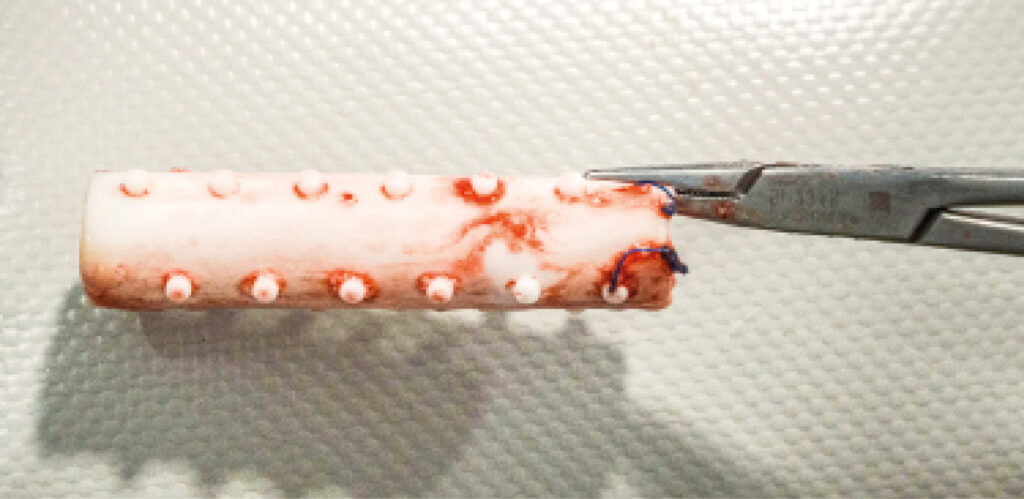 Stent﻿ laríngeo de silicona tras su extracción, con suturas visibles en los extremos. Obsérvese el diseño con espolones para mejorar la fijación intralaríngea.﻿