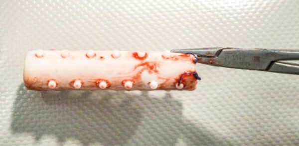 Stent laríngeo de silicona tras su extracción, con suturas visibles en los extremos. Obsérvese el diseño con espolones para mejorar la fijación intralaríngea.