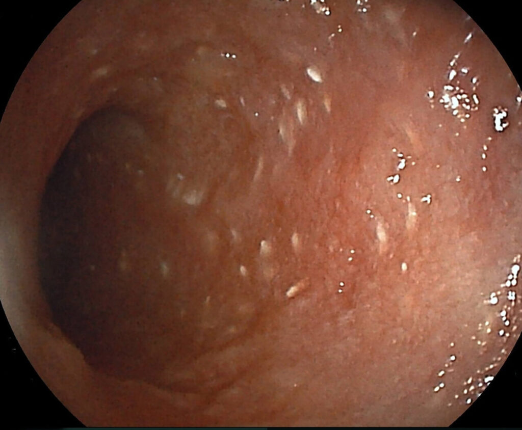 Imagen 3.A Imagen endoscópica de un paciente con linfangiectasia.