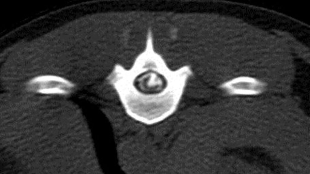 Imagen transversal del mielo-TAC, adquirida en algoritmo de hueso a nivel de T12 del mielo-TAC