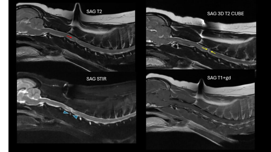 RM, cortes sagitales utilizando distintos tipos de secuencias. Se aprecia un trayecto en dirección dorsal desde el espacio IV C3-C4 hasta el parénquima medular