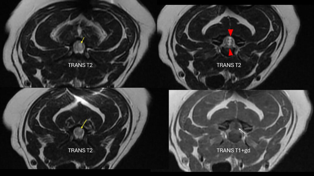 RM, cortes transversales en T2 y T1 poscontraste.
