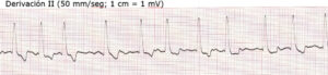 Electrocardiograma de mastín español de 6 años y 60 kg con fatiga e inapetencia y distensión abdominal
