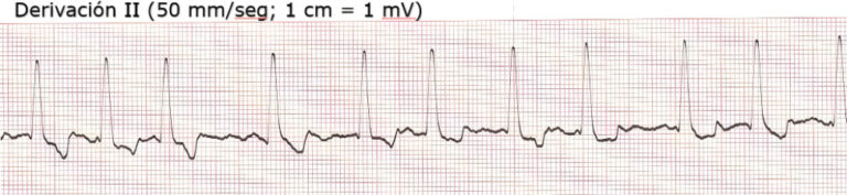 Electrocardiograma de mastín español de 6 años y 60 kg con fatiga e inapetencia y distensión abdominal