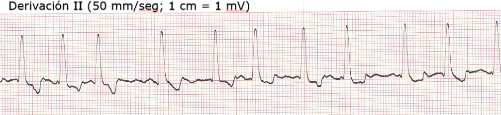 Electrocardiograma de mastín español de 6 años y 60 kg con fatiga e inapetencia y distensión abdominal