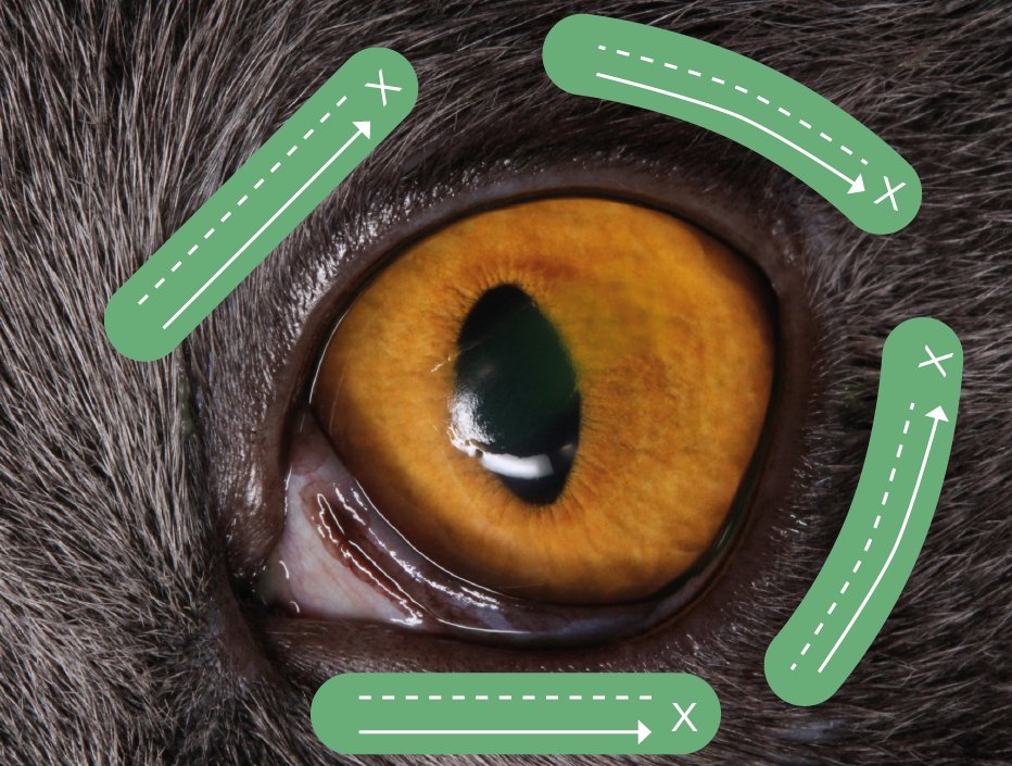 Inyección túnel. Las marcas “X” indican el lugar de inoculación y las formas ovales verdes la distensión del ácido hialurónico.