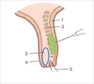 Corte histopatológico del borde palpebral donde se localiza el espacio subdérmico en el que se inyecta el ácido hialurónico (óvalo verde).