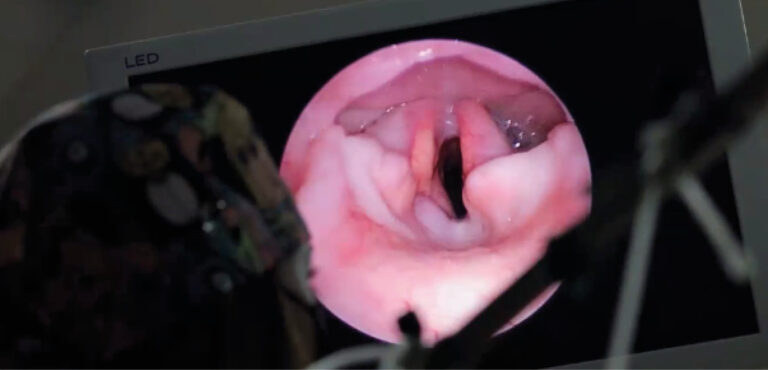 Visualización endoscópica de la glotis en un perro con parálisis laríngea bilateral.