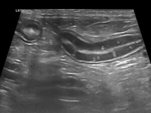 Imagen B - Ecografías de un bulldog francés de 8 años con signos clínicos compatibles con EPP