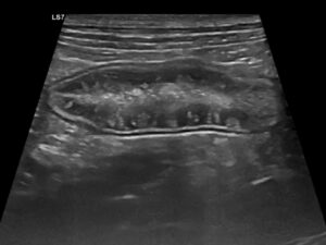 Imagen C - Ecografía de una perra mestiza con hipoalbuminemia grave asociada a una enteropatía inflamatoria