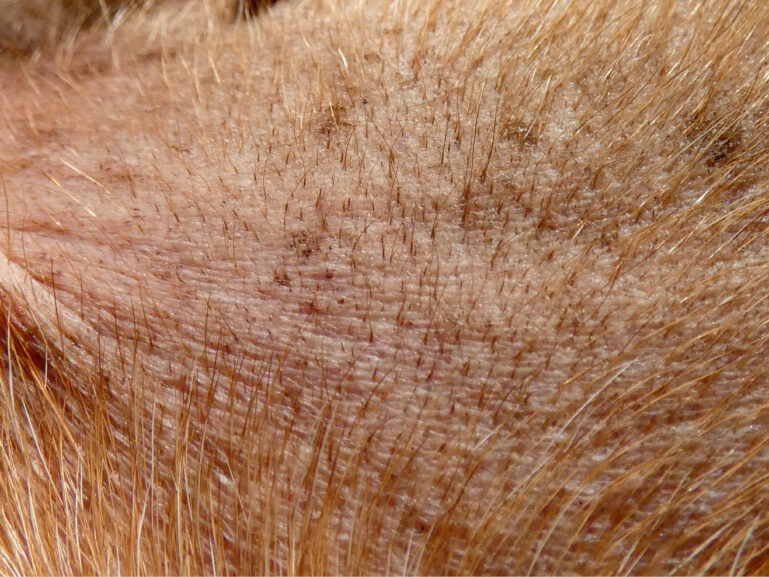 Primer plano del cuero cabelludo con alopecia y cabello fino