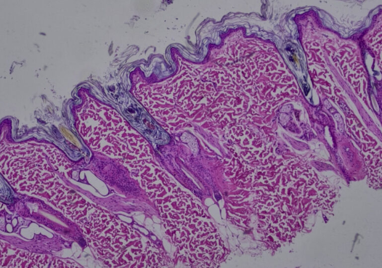 Imagen histológica de un paciente con alopecia X (cedida por Gloria Albinyana).