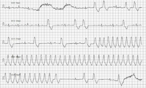 Trazado electrocardiográfico. Latidos sinusales, CPV y una salva de taquicardia ventricular monomórfica paroxística.
