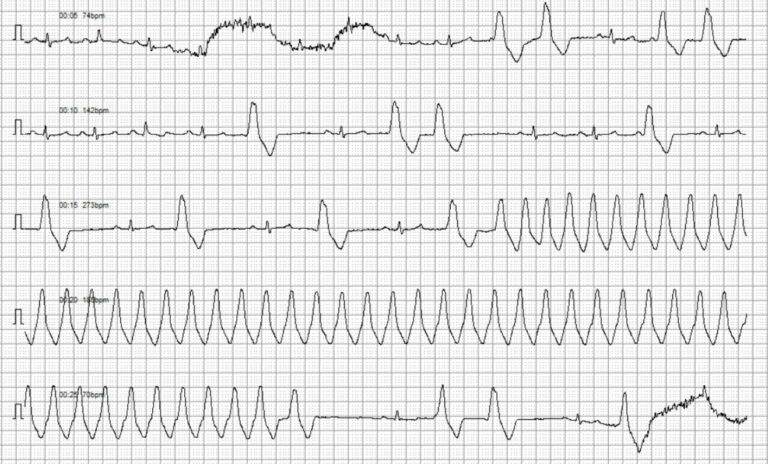 Trazado electrocardiográfico. Latidos sinusales, CPV y una salva de taquicardia ventricular monomórfica paroxística.