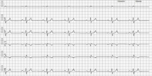 Trazado electrocardiográfico 10 mm/mV y 50 mm/s. Ritmo sinusal.